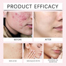 40 pçs de ácido esfoliante coreano para pele, tratamento para acne