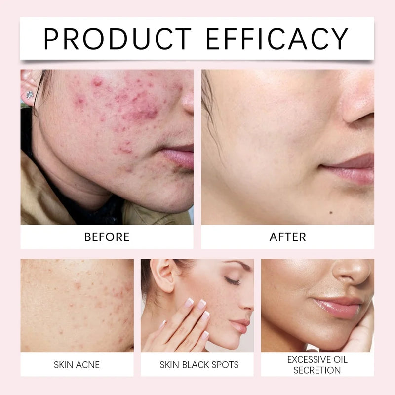 40 pçs de ácido esfoliante coreano para pele, tratamento para acne